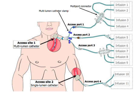 Figure 1. Multiple IV Infusion Setup