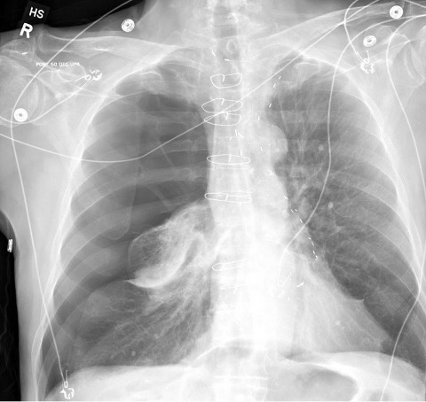 pneumothorax