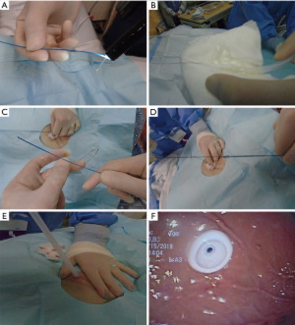 Figure 1. Placement of PEG tube