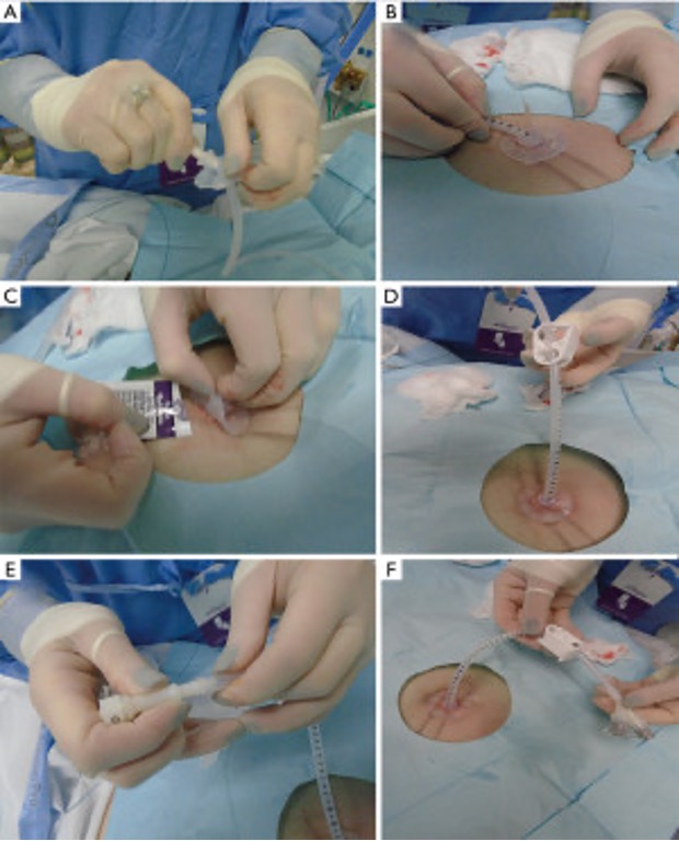 Figure 2. Placement of PEG tube