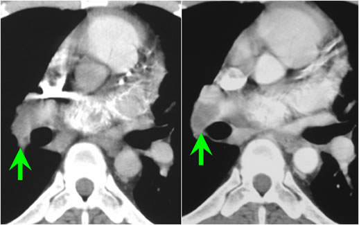 Figure A. Example of CT Showing Improper Bolus Timing