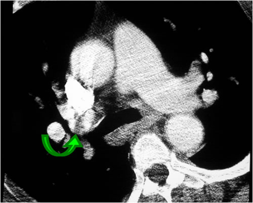 Figure B. Example of CT Showing Streak Artifact