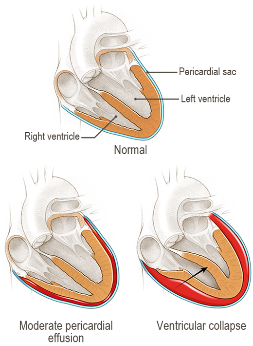 Figure of Normal cardiac anatomy with a progression from a moderate pericardial effusion to one with tamponade physiology due to ventricular collapse.