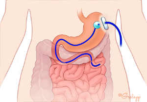 Figure 1 Normal Placement of a Percutaneous Gastrojejunostomy Feeding Tube