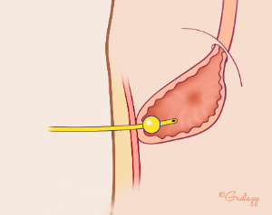 Figure 2 Workaround After the GJ Tube Was Dislodged