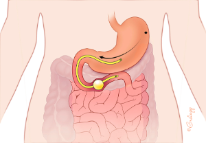 Figure 3 Adverse Event