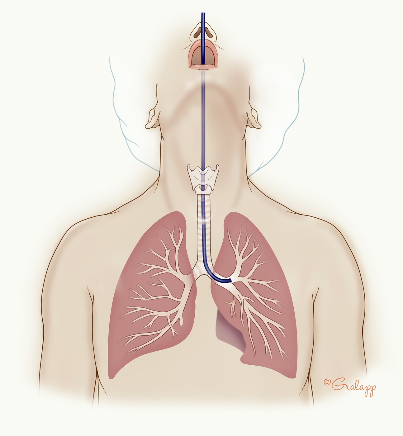 Figure of bronchoscopy