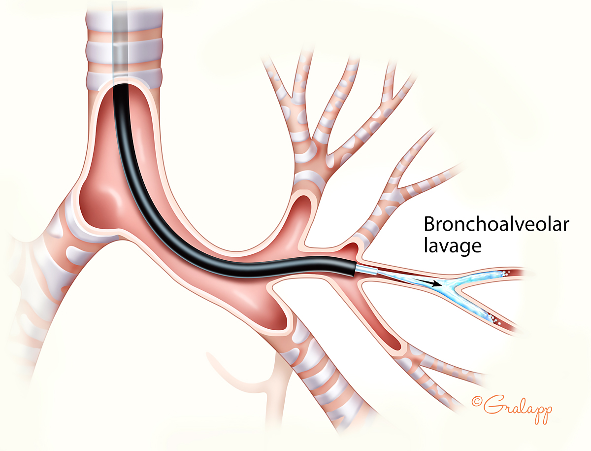 Figure of Bronchoalveolar Lavage