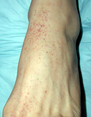 Figure of Petechial Rash