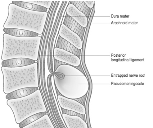 Figure 1. Layers involved in the formation of a pseudomeningocele, with schematic representation of nerve root entrapment at the site of dural defect