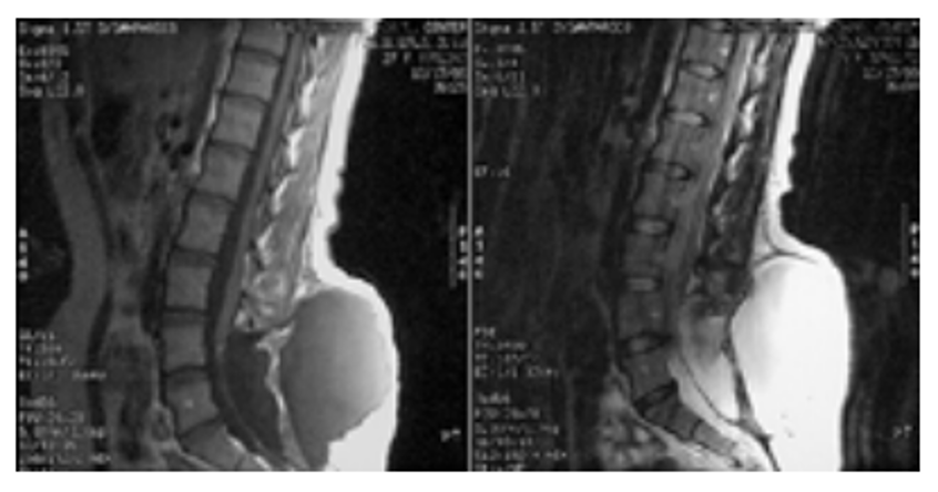 Figure 3. Sagittal T1 (left) and T2 (right) weighted MRI showing a large dorsal fluid collection contiguous with the subarachnoid space.