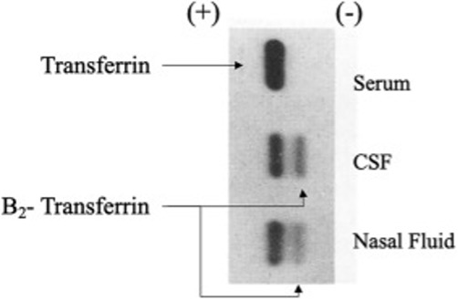 Figure 4. Nasal Fluid Positive for Beta-2 Transferrin Suggesting CSF Source