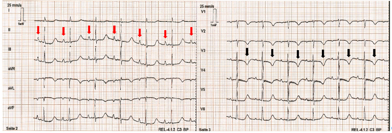 Figure 1 – ECG Demonstrating Hypokalemia