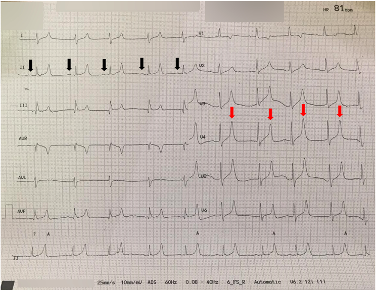 Figure 2 – ECG Demonstrating Hyperkalemia