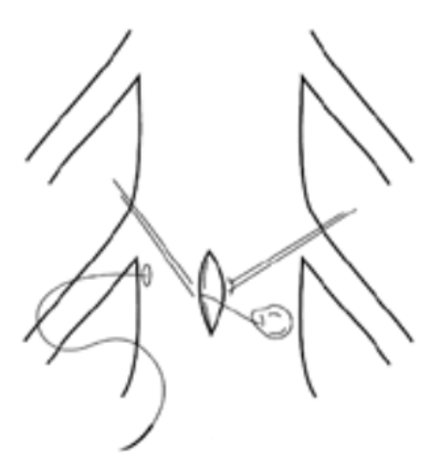 Figure 5. A Schematic Drawing of Mayfield’s Midline Durotomy in Which a Far-Lateral Dural Tear is Repaired